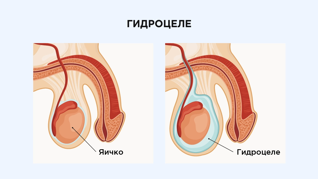 Гидроцеле (водянка яичка) у детей - причины и лечение